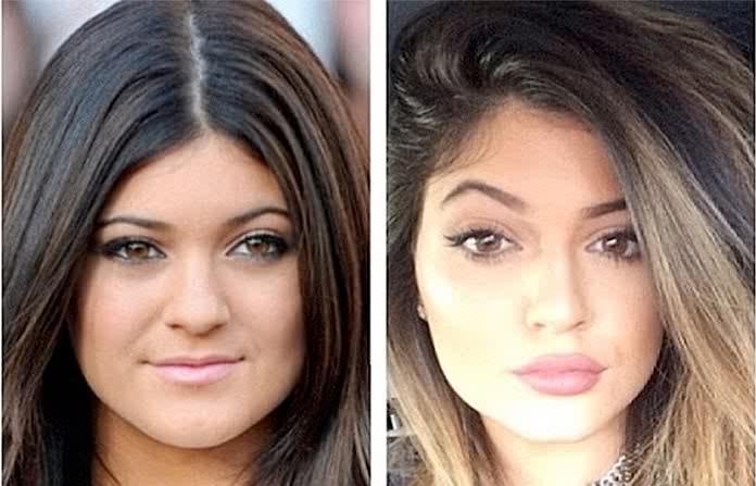Kylie Jenner avant et après chirurgie esthétique